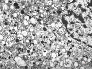 M, 38y. | pheochromocytoma M, 38y. | pheochromocytoma